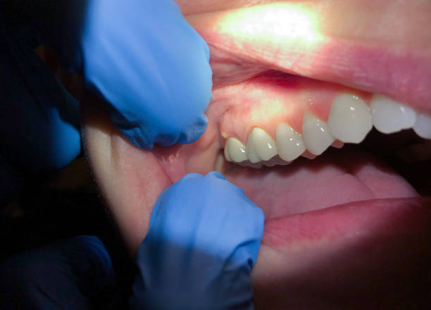 Best Emergency Treatment for Toothache in Mont Clare, PA